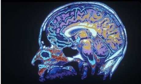 Färglagd sagittal hjärnbild som visar hjärnans inre strukturer